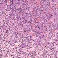 ランゲルハンス細胞組織球症